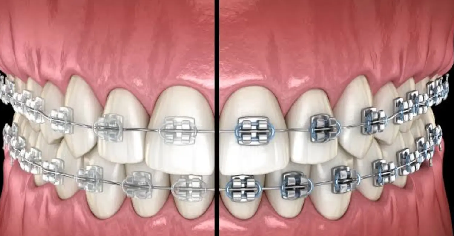 Ceramic vs Metal Braces 2